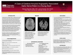 A Case of Cerebral Amyloid Angiopathy-Associated Optic Nerve Pallor in a Young Adult