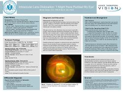 Intraocular Lens Dislocation: “I Might Have Rubbed My Eye”
