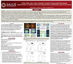 Bhawanjot Minhas, OD A Hop, Skip, and a Jump: Ganglion Complex Transsynaptic Retrograde Degeneration in a Patient with Ocular Hypertension Following Occipital Lobe Stroke