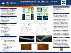 Pigmentary glaucoma with a side of optic nerve staphyloma