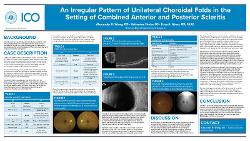 Alexander Wong, OD An Irregular Pattern of Unilateral Choroidal Folds in the Setting of Combined Anterior and Posterior Scleritis