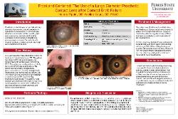 Helene Pippin, OD Front and Centered: The Use of a Large Diameter Prosthetic Contact Lens after Corneal Graft Failure