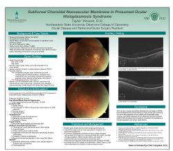 Subfoveal Choroidal Neovascular Membrane in Presumed Ocular Histoplasmosis Syndrome