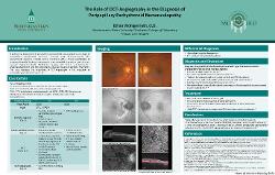 Ethan Wohlgemuth, OD The Role of OCT-Angiography in the Diagnosis of Peripapillary Pachychoroid Neovasculopathy