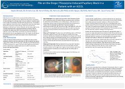 Angelo Shimada, OD Pile on the Drops! Pilocarpine Induced Pupillary Block in a Patient with an ACIOL