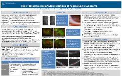 Caroline Donato, OD The Progressive Ocular Manifestations of Kearns-Sayre Syndrome