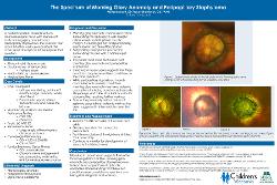 McKenna Scott, OD The Spectrum of Morning Glory Anomaly and Peripapillary Staphyloma