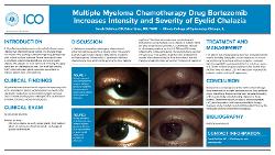 Sarah DeVries, OD Multiple Myeloma Chemotherapy Drug Bortezomib Increases Intensity and Severity of Eyelid Chalazia