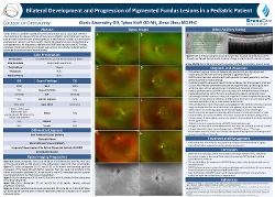 Bilateral Development and Progression of Pigmented Fundus Lesions in a Pediatric Patient
