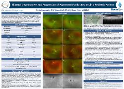 Alexis Abernathy, OD Bilateral Development and Progression of Pigmented Fundus Lesions in a Pediatric Patient