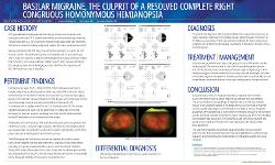 Basilar Migraine, The Culprit of a Resolved Complete Right Congruous Homonymous Hemianopsia