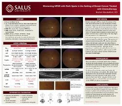 Worsening NPDR with Roth Spots in the Setting of Breast Cancer treated with Chemotherapy