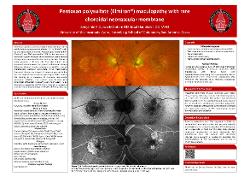 Benjamin Quach, OD Pentosan polysulfate (Elmiron) maculopathy with rare choroidal neovascular membrane