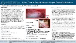 A Rare Case of Punctal Stenosis: Herpes Zoster Ophthalmicus