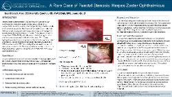 Geerdhana Arun, OD A Rare Case of Punctal Stenosis: Herpes Zoster Ophthalmicus