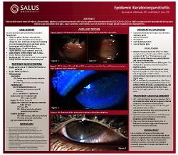 Amanda Whitbeck, OD Epidemic Keratoconjunctivitis