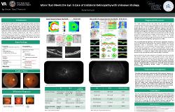 Redha Tareen, OD “More than meets the Eye” - A Case of Unilateral Retinopathy with Unknown Etiology