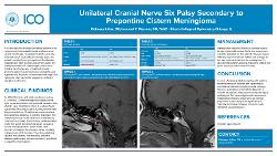 Unilateral Cranial Nerve Six Palsy Secondary to Prepontine Cistern Meningioma
