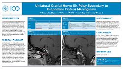 Moheera Athar, OD Unilateral Cranial Nerve Six Palsy Secondary to Prepontine Cistern Meningioma