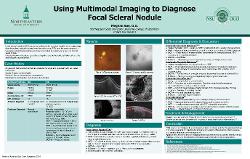 Using Multimodal Imaging to Diagnose Focal Scleral Nodule