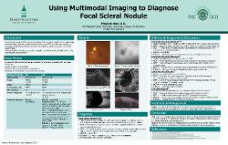 Meghan Sue, OD Using Multimodal Imaging to Diagnose Focal Scleral Nodule