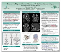 Tales of the Trigeminal Nerve: A Case of a Meningioma Masquerading as Herpes Zoster Ophthalmicus