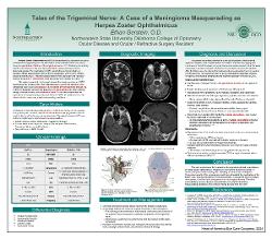 Ethan Gerstein, OD Tales of the Trigeminal Nerve: A Case of a Meningioma Masquerading as Herpes Zoster Ophthalmicus