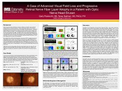 Carly Poskochil, BS A Case of Advanced Visual Field Loss and Progressive Retinal Nerve Fiber Layer Atrophy in a Patient with Optic Nerve Head Drusen