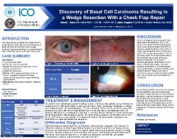 Demetra Danos, OD Discovery of Basal Cell Carcinoma Resulting in Wedge Resection With Frozen Margins
