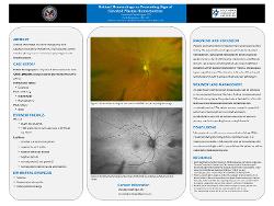 Retinal Hemorrhage as Presenting Sign of Elevated Plasma Homocysteine