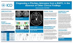 Alyssa Lancaster, OD Diagnosing a Pituitary Adenoma from a RAPD, in the Absence of Other Clinical Findings
