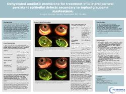 Austin Toresdahl, OD Dehydrated amniotic membrane for the treatment of bilateral corneal persistent epithelial defects due to topical glaucoma medicines and BAK toxicity