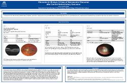 Juna Lee, OD Glaucoma in 30-days: A case of Neovascular Glaucoma after Central Retinal Artery Occlusion