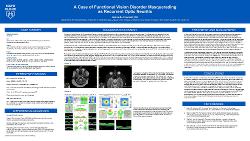 Gabrielle Crockett, OD A Case of Functional Vision Disorder Masquerading as Recurrent Optic Neuritis