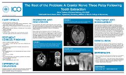 The Root of the Problem: A Cranial Nerve Three Palsy Following Tooth Extraction