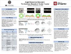 Angle Recession Glaucoma: The Insidious Sequela of Ocular Trauma