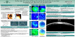 Wincy Chung, OD To Fit or Not to Fit: A Case of a Corneal Gas-Permeable Fit on a Corneal Graft and Referring Out a Corneal Graft Rejection
