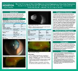 Shabistan Asrar, OD TB or not TB? A Case of Ciliary Body Melanoma Initially Diagnosed as a Ciliary Body Tuberculoma
