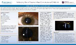 Perforating Ocular Trauma: A Rare Complication of Childbirth