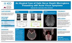 Baljinder Dheri, Student An Atypical Case of Optic Nerve Sheath Meningioma Presenting with Acute Visual Symptoms