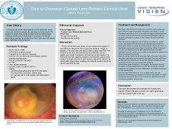 Dare to Overwear: Contact Lens Related Corneal Ulcer