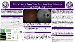 Trizonal Twists: A Case of Acute Zonal Occult Outer Retinopathy (AZOOR)