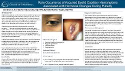 Geerdhana Arun, OD Rare occurrence of acquired eyelid capillary hemangioma associated with hormonal changes during puberty