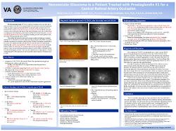Vivian Cao, OD Neovascular Glaucoma in a Patient Treated with Prostaglandin E1 for a Central Retinal Artery Occlusion