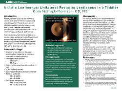 A Little Lenticonus: Unilateral Posterior Lenticonus in a Toddler