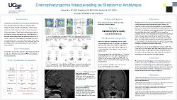 Craniopharyngioma Masquerading as Strabismic Amblyopia