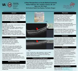 A New Perspective on Acute Retinal Ischemia