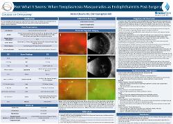 Not What It Seems: When Toxoplasmosis Masquerades as Endophthalmitis Post-Surgery