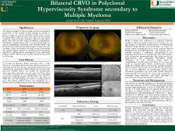 Bilateral CRVO in Polyclonal Hyperviscosity Syndrome Secondary to Multiple Myeloma