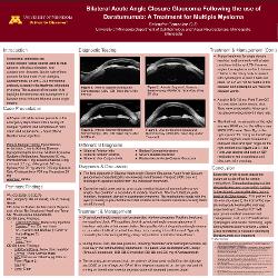 Bilateral Acute Angle Closure Glaucoma Following the use of Daratumumab: A Treatment for Multiple Myeloma
